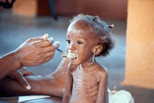 Starving child in Somalia
